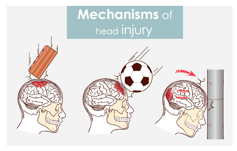 mechanisms_of_head_injury.jpg