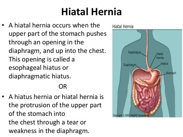 hiatal-hernia-2-638.jpg